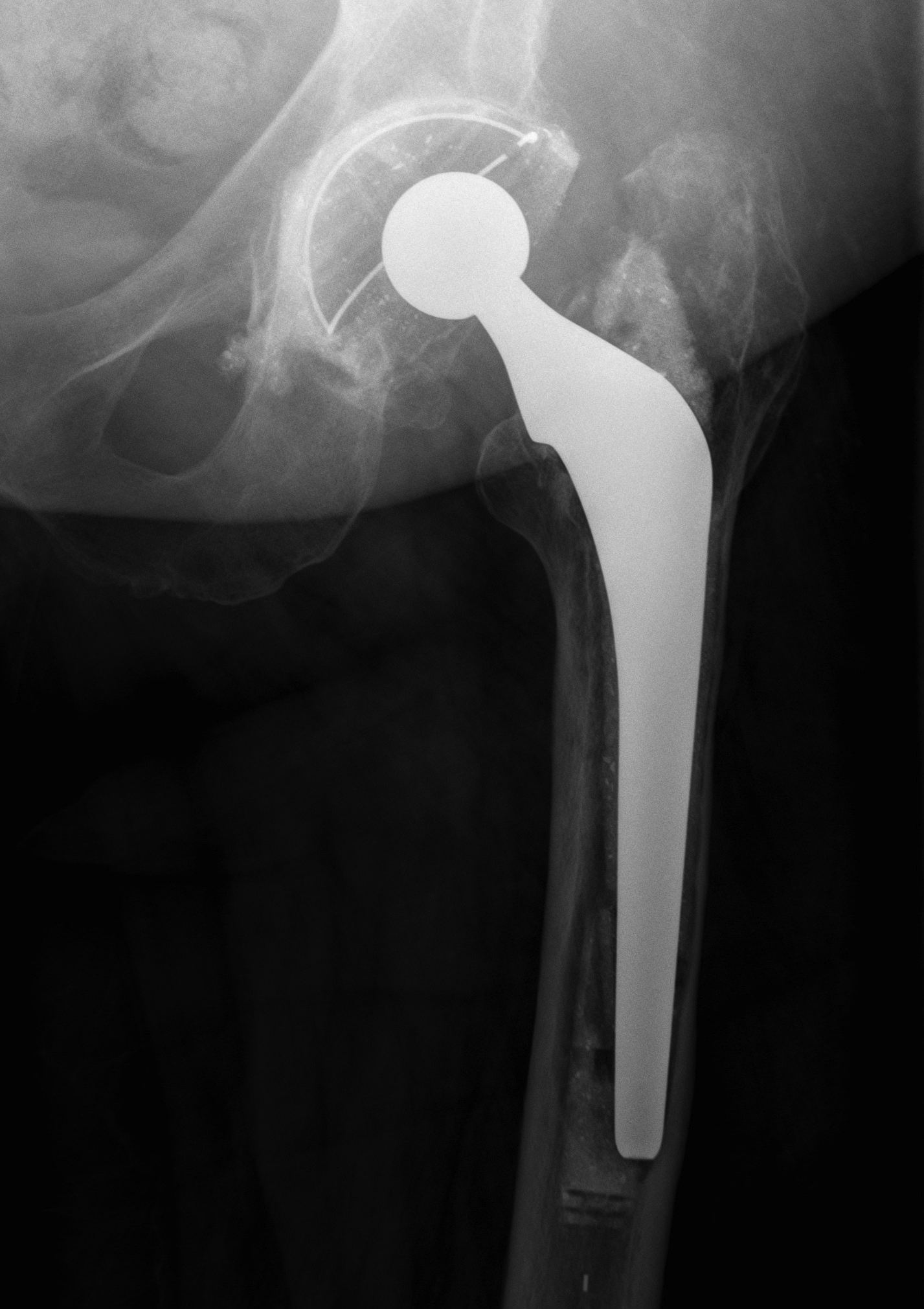 Revision Femur Type IIIA Pre Impaction Bone Grafting